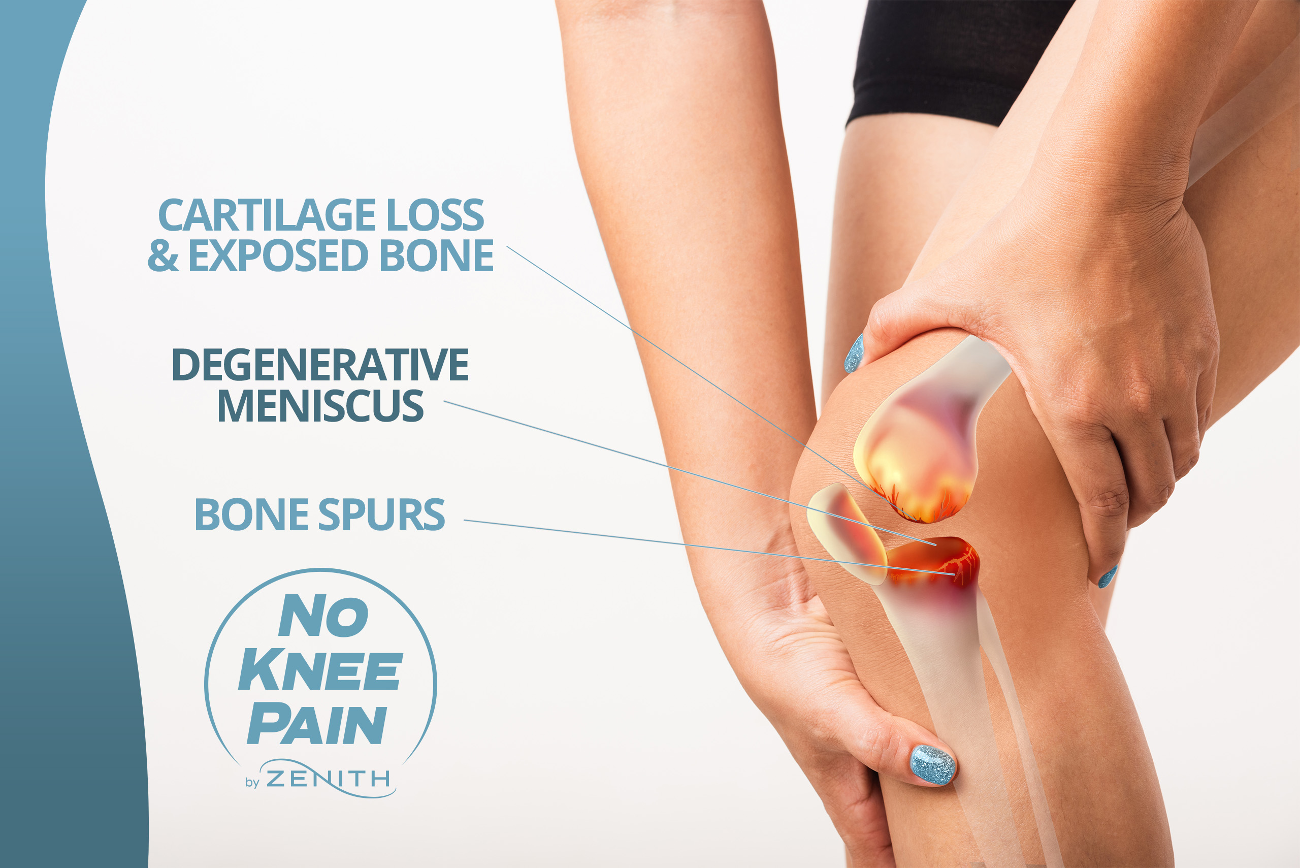 zenith vascular and fibroid center illustration of cartilage loss and exposed bone, degenerative meniscus, and bone spurs