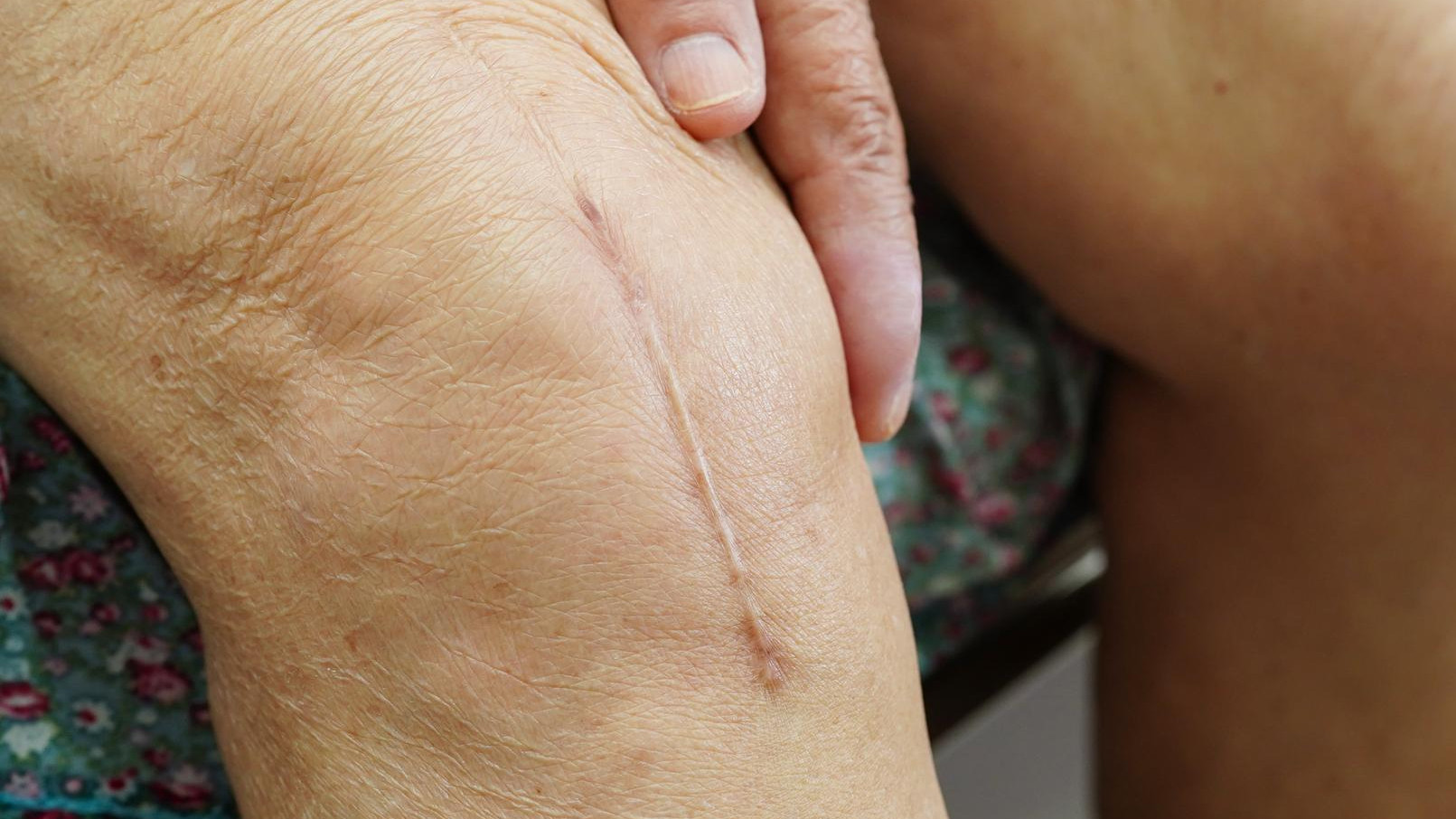 avoid knee surgery scar horiz